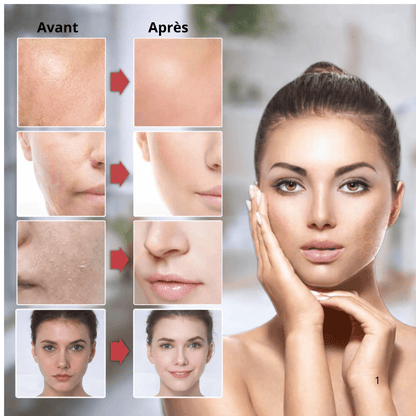 Appareil massage visage hifu avant apres peau